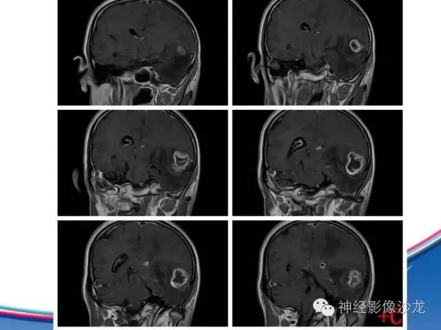 【病例】胶质母细胞瘤1例MR影像表现