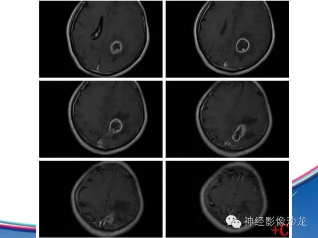 【病例】胶质母细胞瘤1例MR影像表现