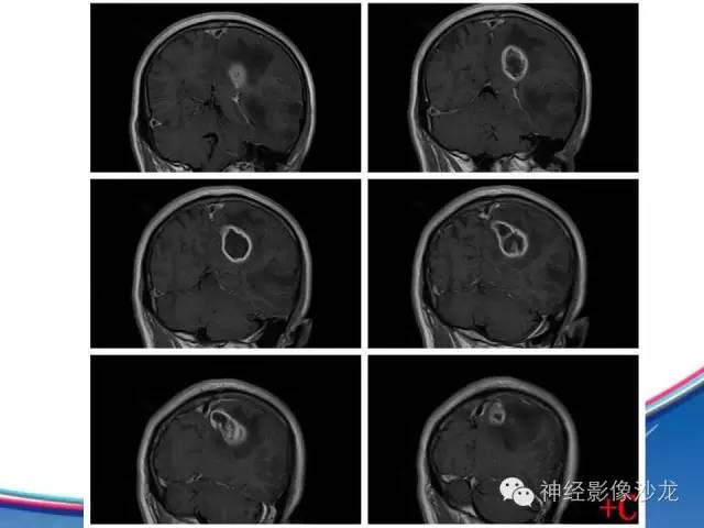 【病例】胶质母细胞瘤1例MR影像表现