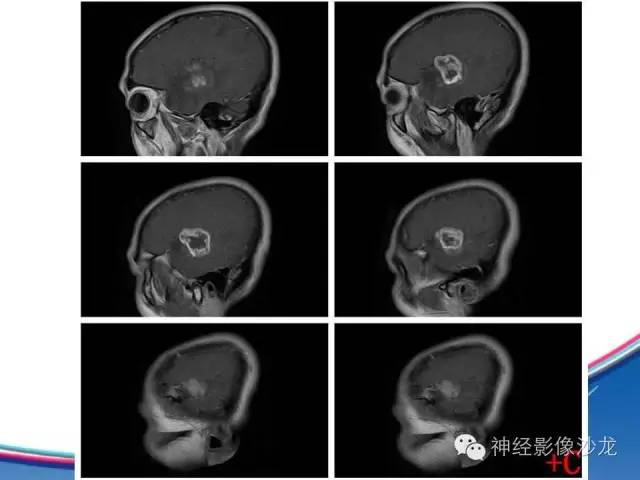 【病例】胶质母细胞瘤1例MR影像表现