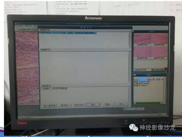 【病例】胶质母细胞瘤1例MR影像表现