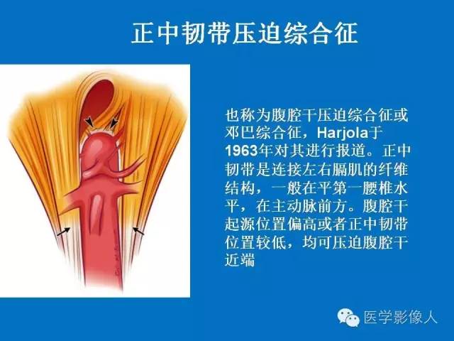 【PPT】腹、盆腔血管压迫综合征的多层螺旋CT表现