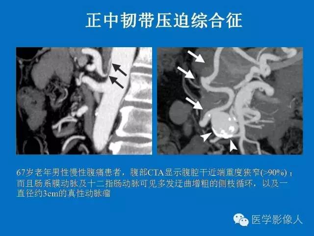 【PPT】腹、盆腔血管压迫综合征的多层螺旋CT表现