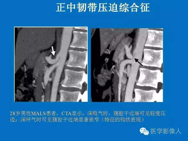 【PPT】腹、盆腔血管压迫综合征的多层螺旋CT表现