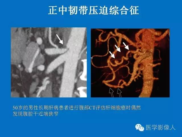 【PPT】腹、盆腔血管压迫综合征的多层螺旋CT表现