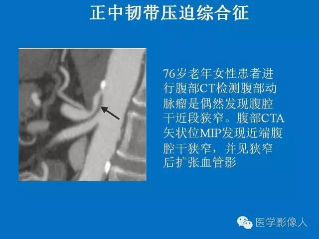 【PPT】腹、盆腔血管压迫综合征的多层螺旋CT表现