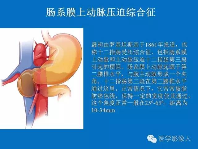 【PPT】腹、盆腔血管压迫综合征的多层螺旋CT表现