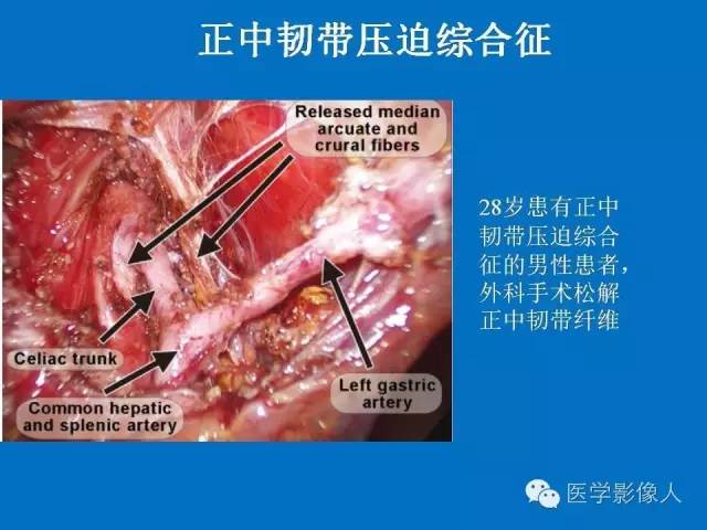【PPT】腹、盆腔血管压迫综合征的多层螺旋CT表现