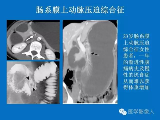 【PPT】腹、盆腔血管压迫综合征的多层螺旋CT表现