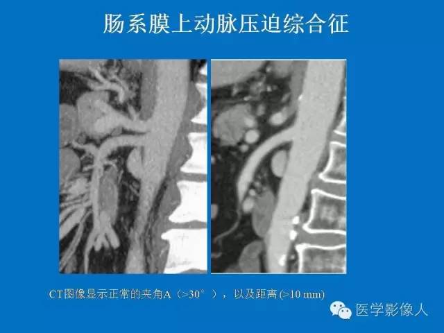 【PPT】腹、盆腔血管压迫综合征的多层螺旋CT表现