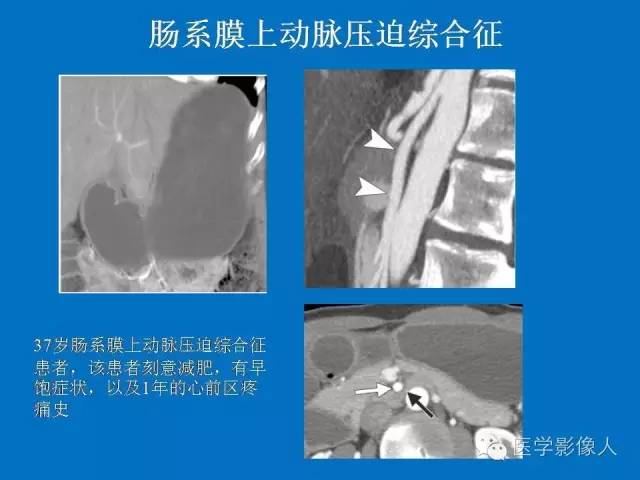 【PPT】腹、盆腔血管压迫综合征的多层螺旋CT表现
