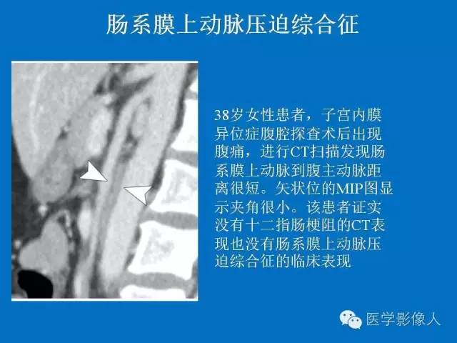 【PPT】腹、盆腔血管压迫综合征的多层螺旋CT表现
