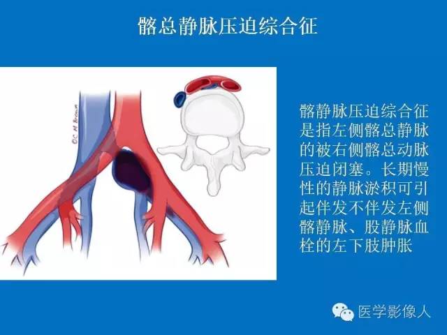 【PPT】腹、盆腔血管压迫综合征的多层螺旋CT表现