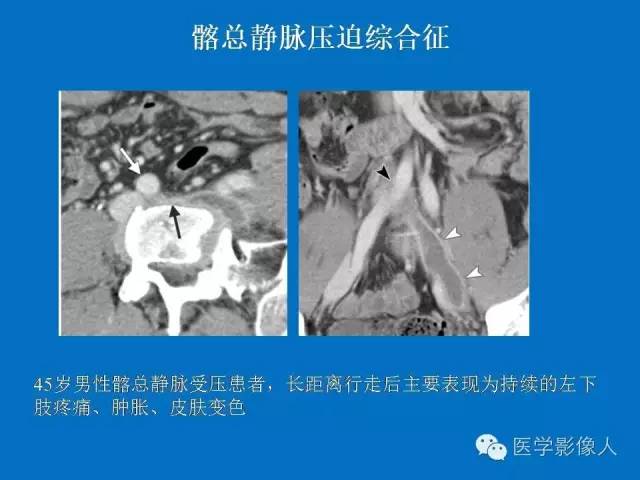 【PPT】腹、盆腔血管压迫综合征的多层螺旋CT表现