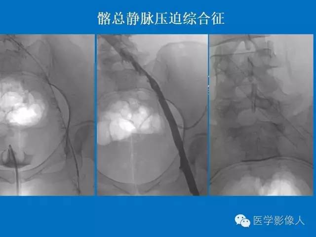 【PPT】腹、盆腔血管压迫综合征的多层螺旋CT表现