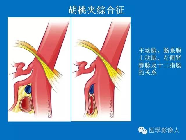 【PPT】腹、盆腔血管压迫综合征的多层螺旋CT表现
