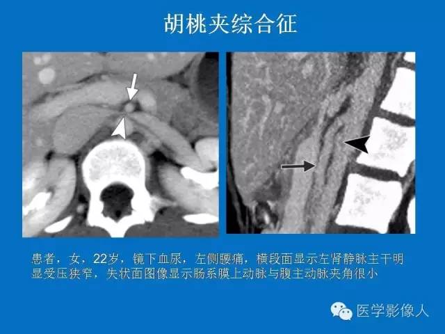 【PPT】腹、盆腔血管压迫综合征的多层螺旋CT表现