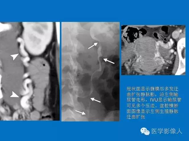 【PPT】腹、盆腔血管压迫综合征的多层螺旋CT表现