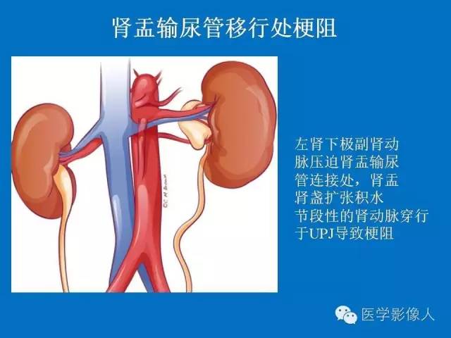 【PPT】腹、盆腔血管压迫综合征的多层螺旋CT表现