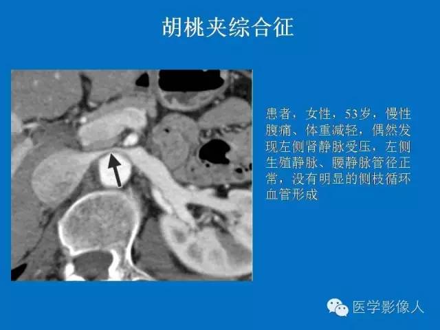 【PPT】腹、盆腔血管压迫综合征的多层螺旋CT表现