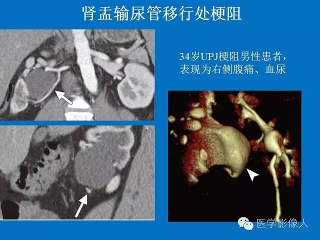 【PPT】腹、盆腔血管压迫综合征的多层螺旋CT表现