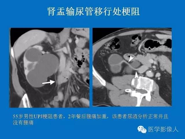 【PPT】腹、盆腔血管压迫综合征的多层螺旋CT表现