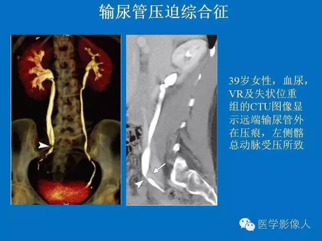 【PPT】腹、盆腔血管压迫综合征的多层螺旋CT表现