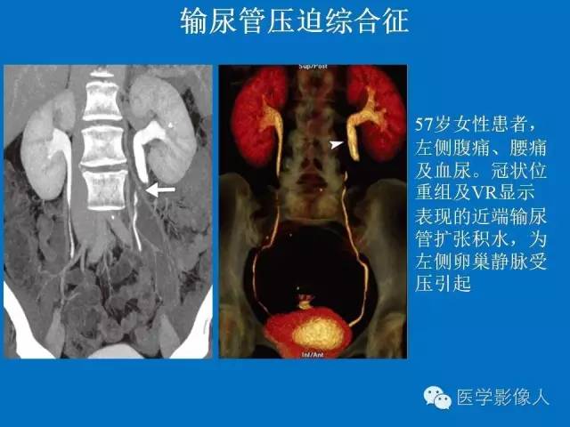 【PPT】腹、盆腔血管压迫综合征的多层螺旋CT表现