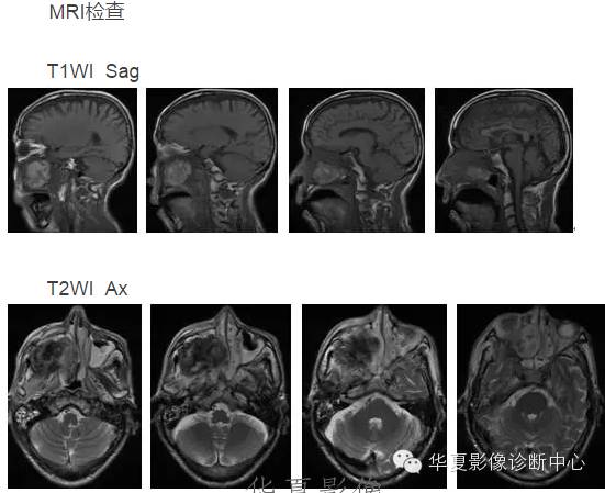 发生在皮肤外的黑色素,也许MR表现和您想的不一样 发生在皮肤外的黑色素,也许MR表现和您想的不一样