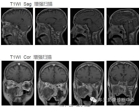 发生在皮肤外的黑色素,也许MR表现和您想的不一样 发生在皮肤外的黑色素,也许MR表现和您想的不一样