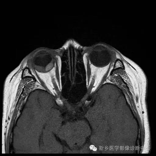发生在皮肤外的黑色素,也许MR表现和您想的不一样 发生在皮肤外的黑色素,也许MR表现和您想的不一样