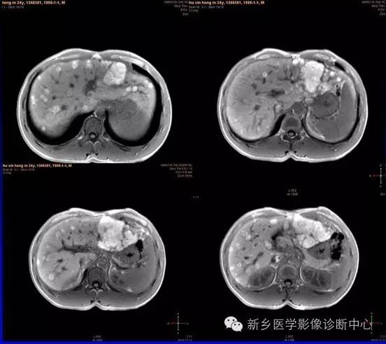 发生在皮肤外的黑色素,也许MR表现和您想的不一样 发生在皮肤外的黑色素,也许MR表现和您想的不一样