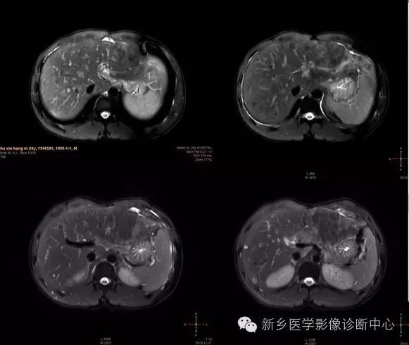 发生在皮肤外的黑色素,也许MR表现和您想的不一样 发生在皮肤外的黑色素,也许MR表现和您想的不一样