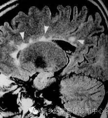 五个方面认识多发性硬化