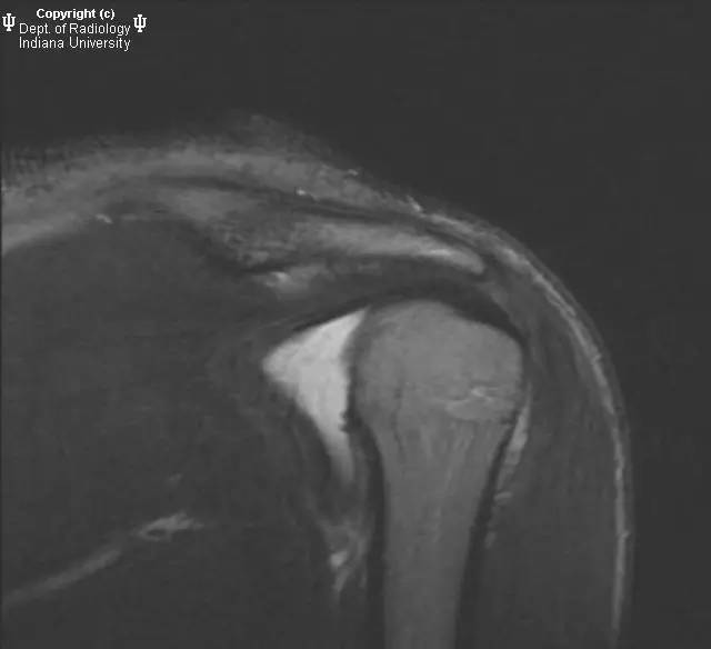 【病例】盂肱韧带肱骨撕脱1例MR影像表现