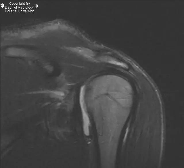 【病例】盂肱韧带肱骨撕脱1例MR影像表现