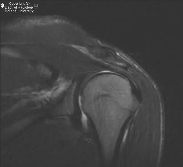 【病例】盂肱韧带肱骨撕脱1例MR影像表现