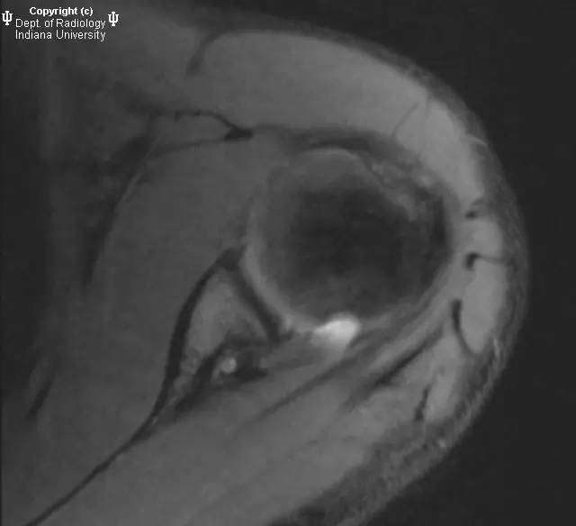 【病例】盂肱韧带肱骨撕脱1例MR影像表现