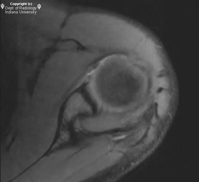 【病例】盂肱韧带肱骨撕脱1例MR影像表现