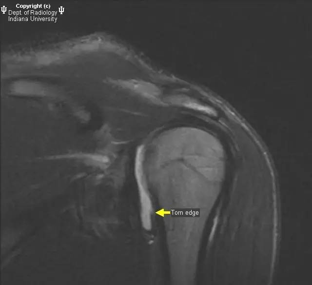 【病例】盂肱韧带肱骨撕脱1例MR影像表现