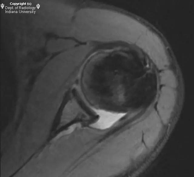 【病例】盂肱韧带肱骨撕脱1例MR影像表现