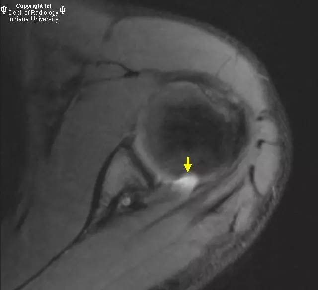 【病例】盂肱韧带肱骨撕脱1例MR影像表现