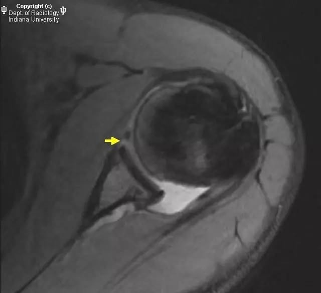【病例】盂肱韧带肱骨撕脱1例MR影像表现