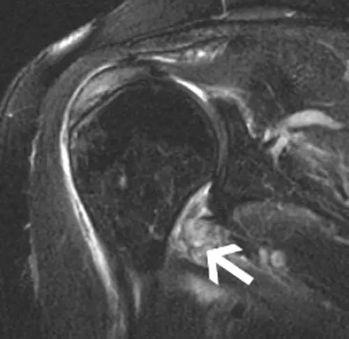 【病例】盂肱韧带肱骨撕脱1例MR影像表现