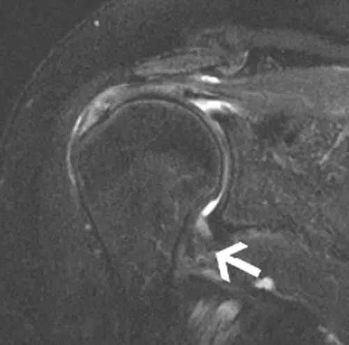 【病例】盂肱韧带肱骨撕脱1例MR影像表现