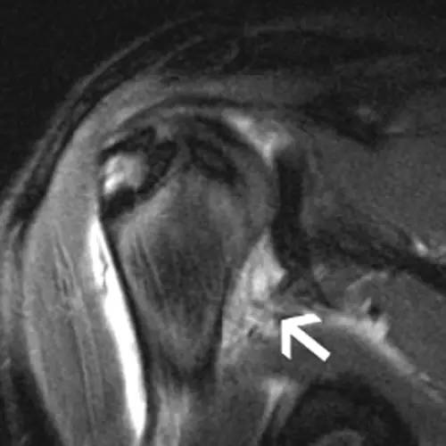 【病例】盂肱韧带肱骨撕脱1例MR影像表现