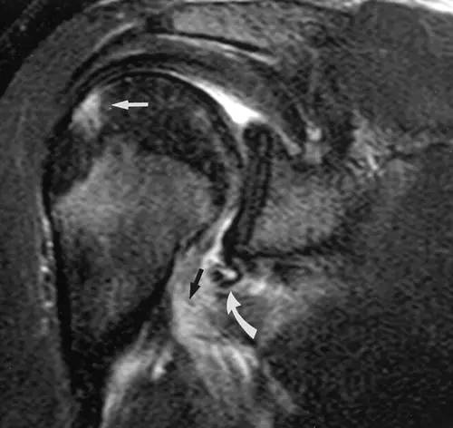 【病例】盂肱韧带肱骨撕脱1例MR影像表现