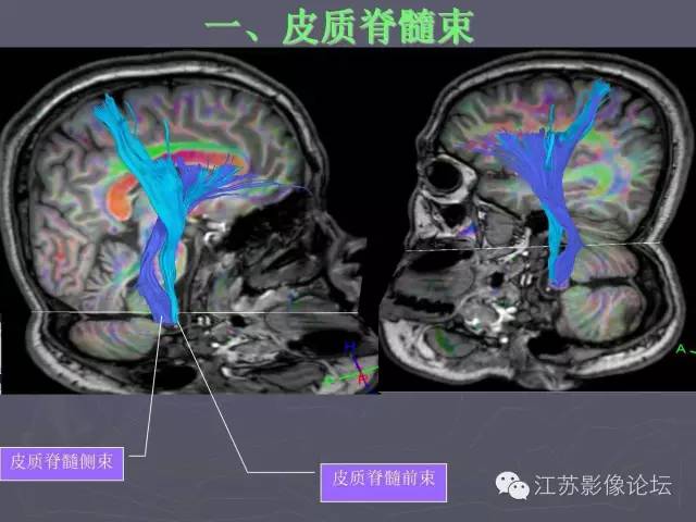 【PPT】磁共振DTI成像-投射纤维