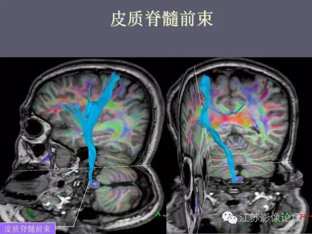 【PPT】磁共振DTI成像-投射纤维