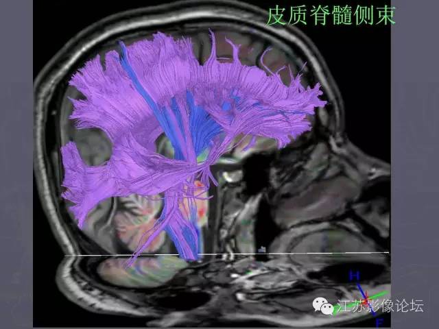【PPT】磁共振DTI成像-投射纤维